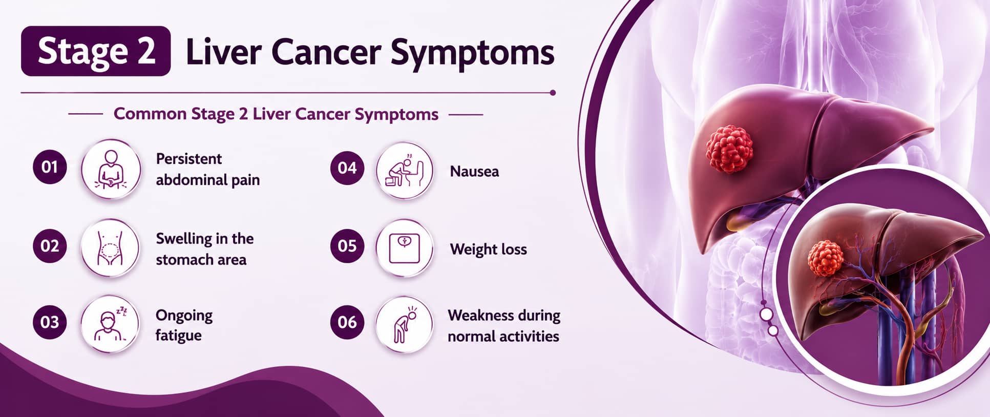 Stage 2 Liver Cancer Symptoms