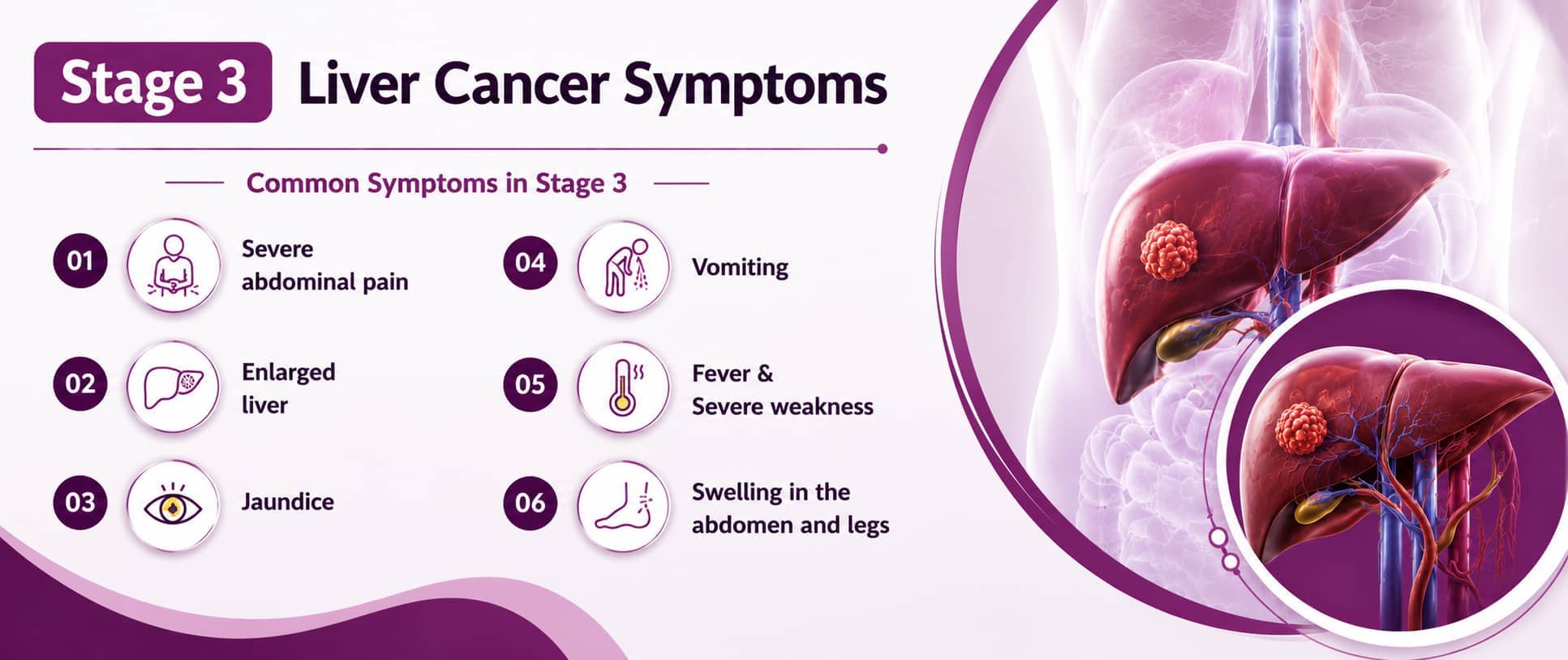 Stage 3 Liver Cancer Symptoms