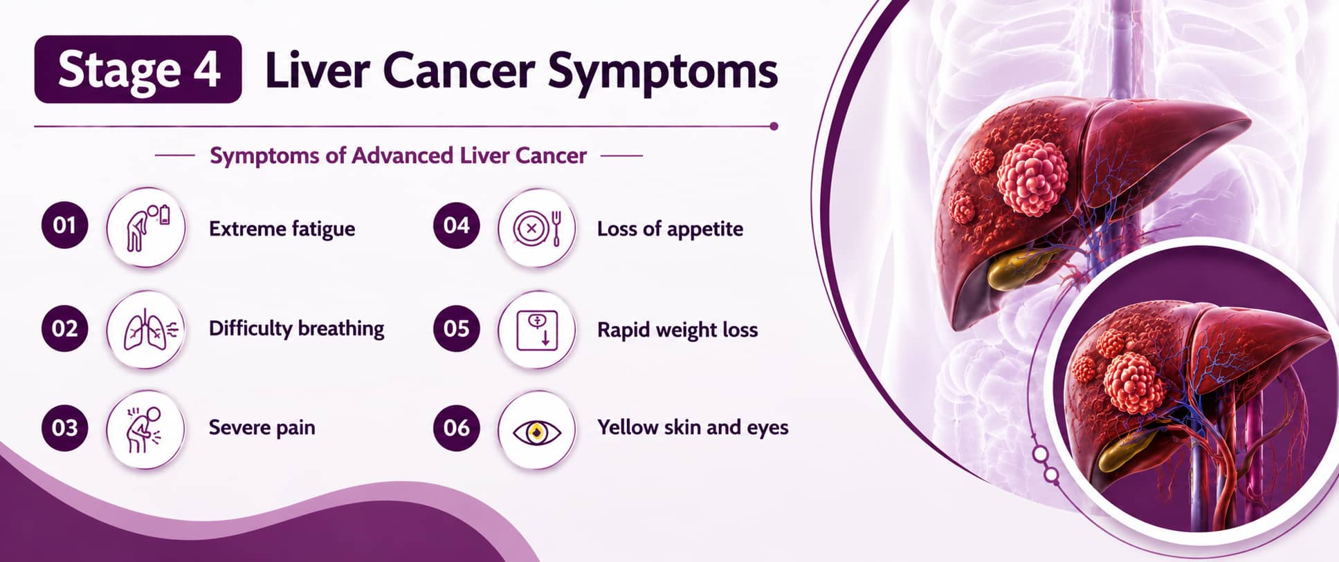 Stage 4 liver cancer symptoms