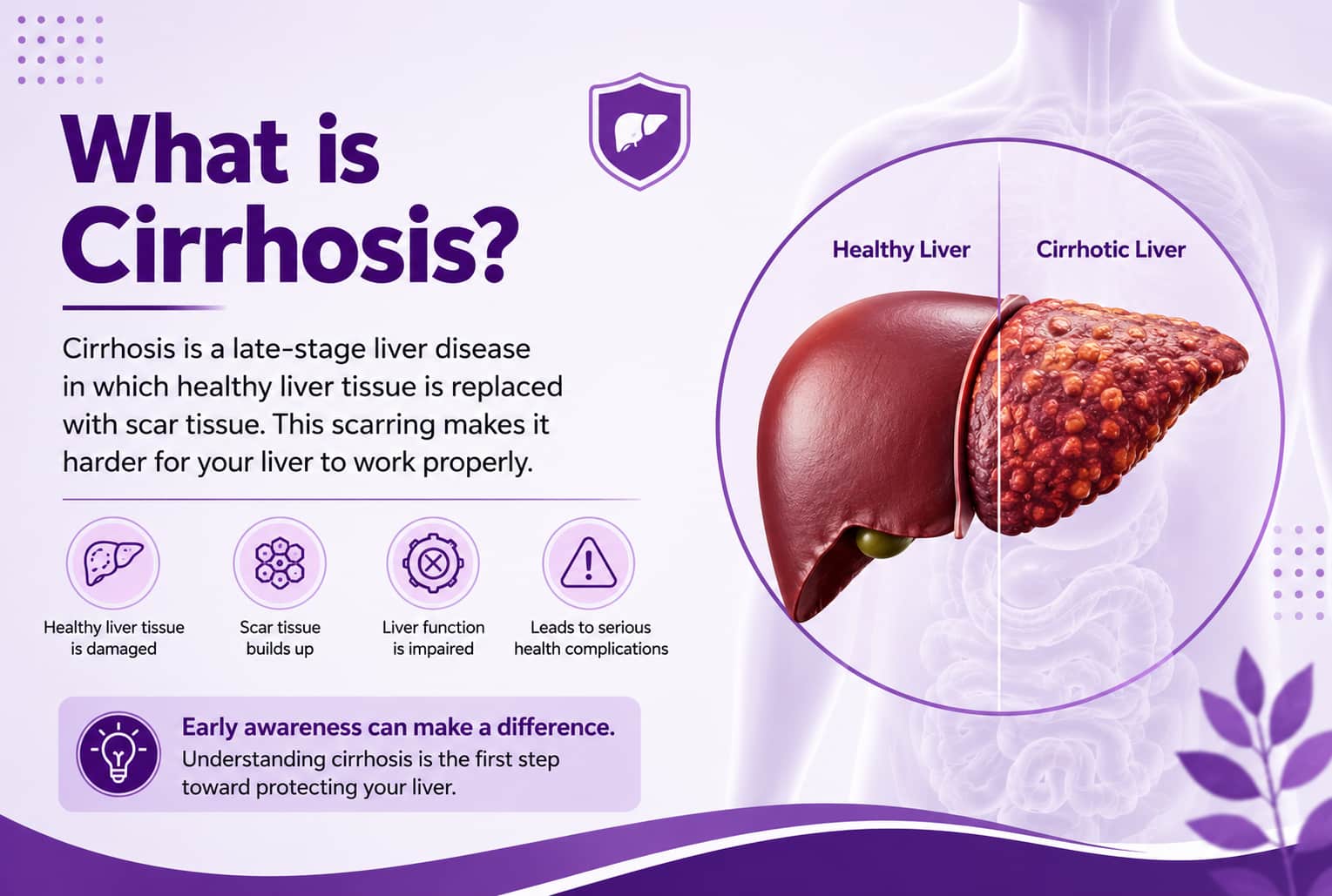 What is Cirrhosis?
