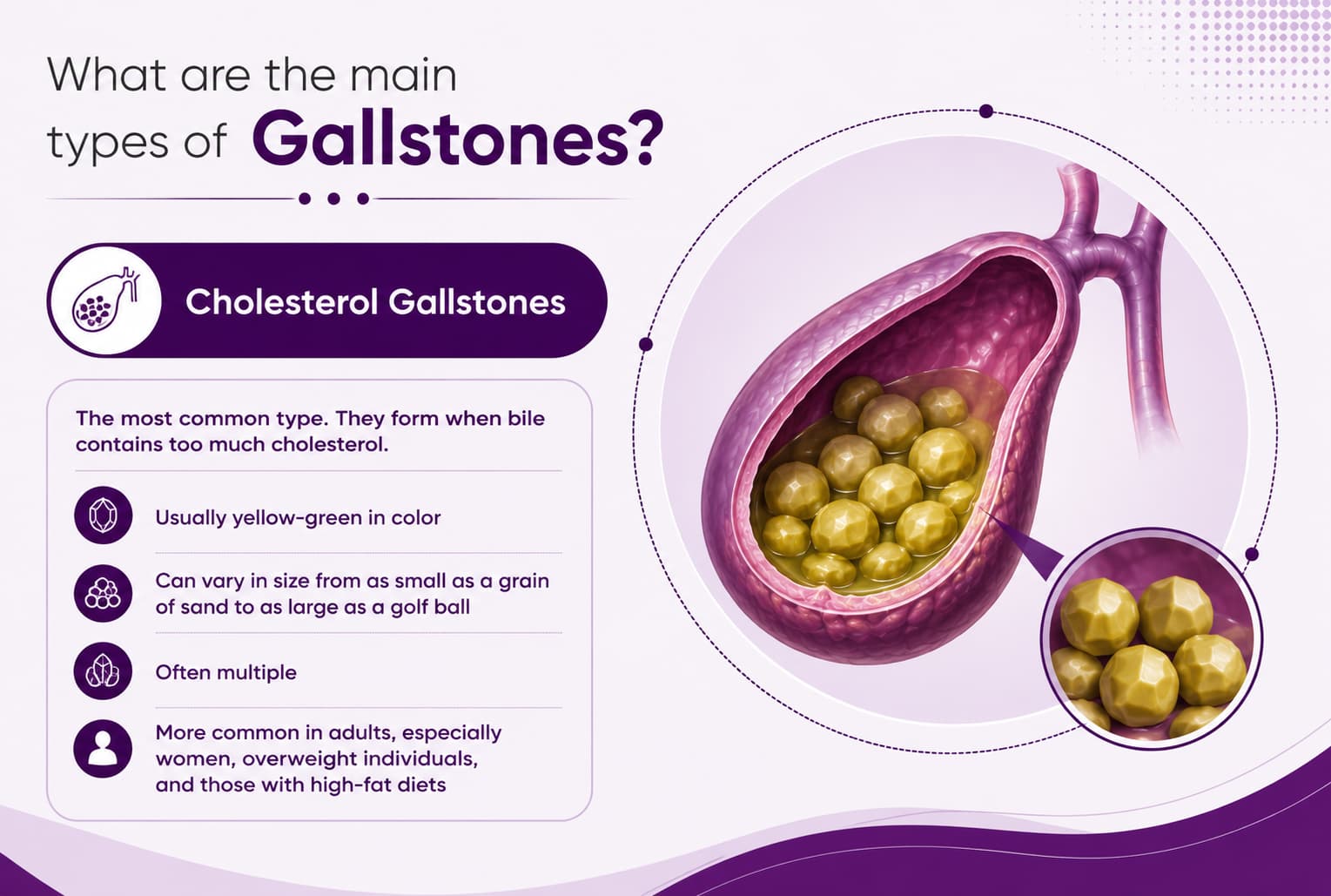 Cholesterol Gallstones