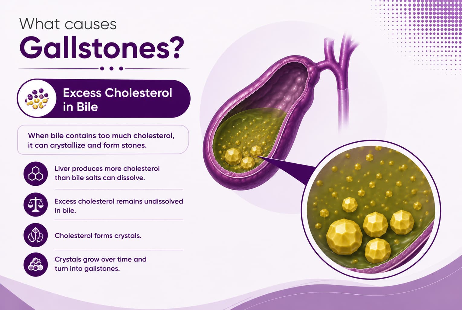 Excess Cholesterol in Bile