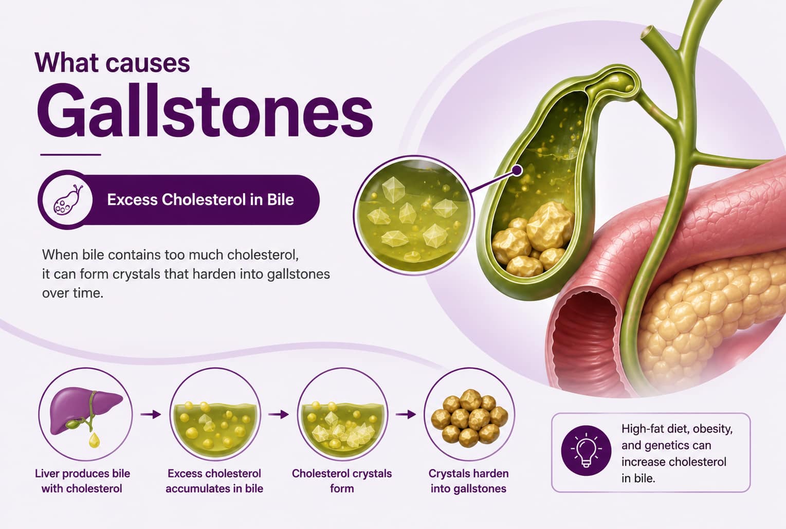 Excess Cholesterol in Bile