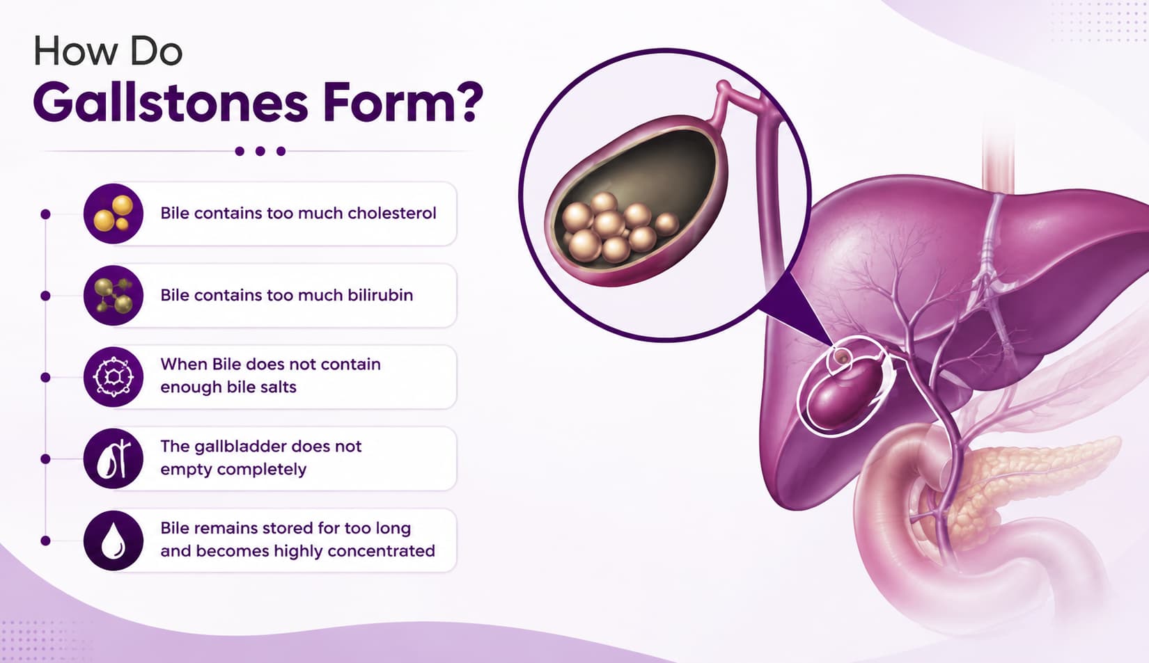 How Do Gallstones Form