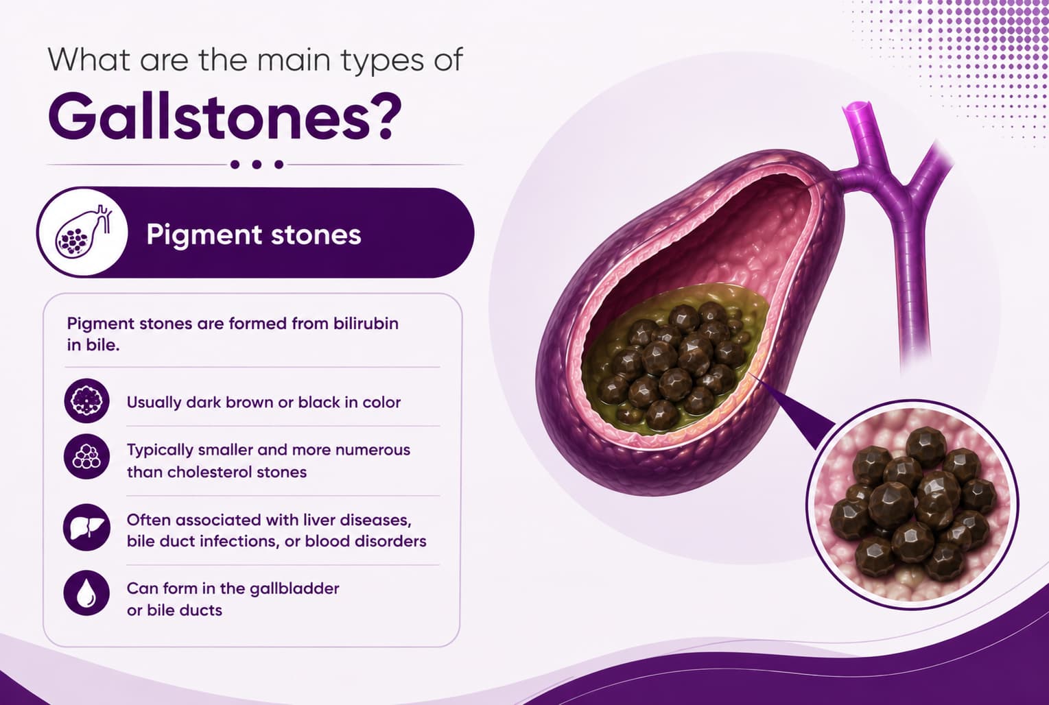 Pigment stones
