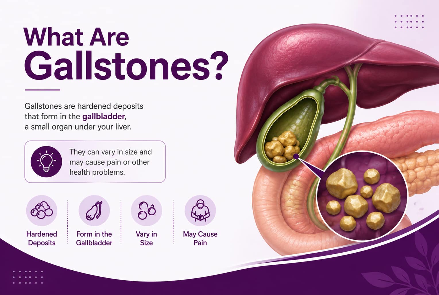 What Are Gallstones?