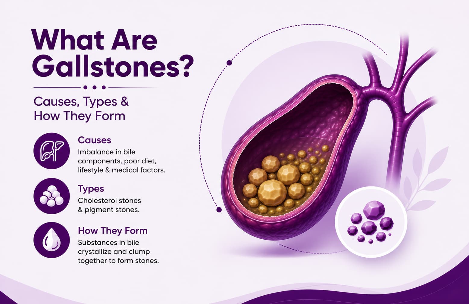What Are Gallstones? Causes, Types & How They Form