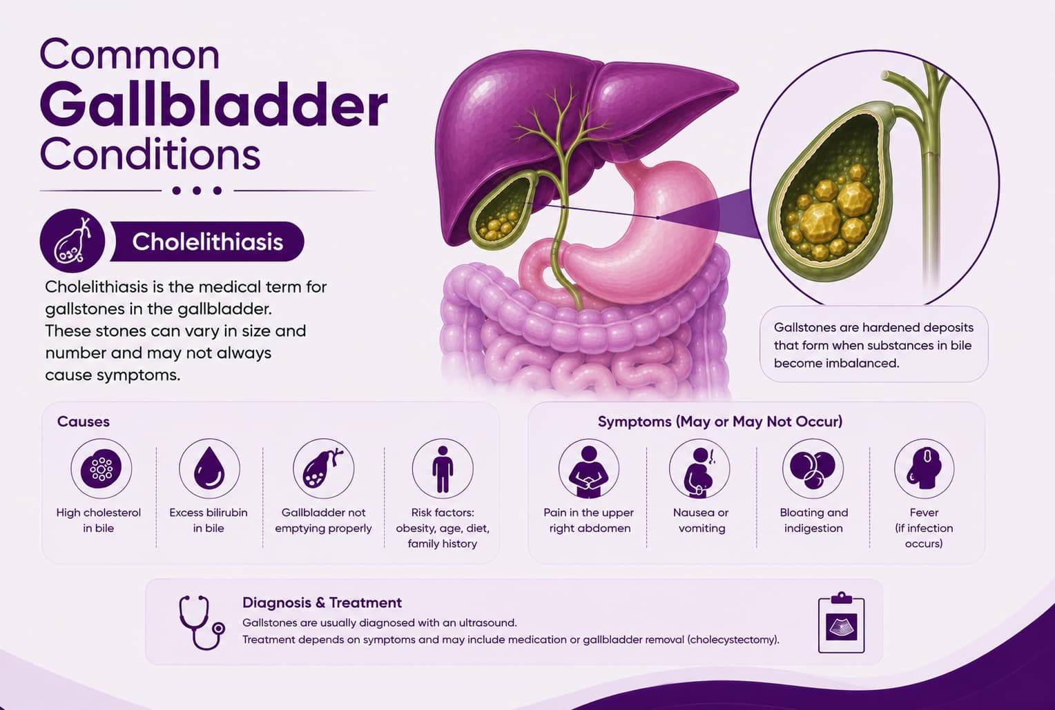 Cholelithiasis