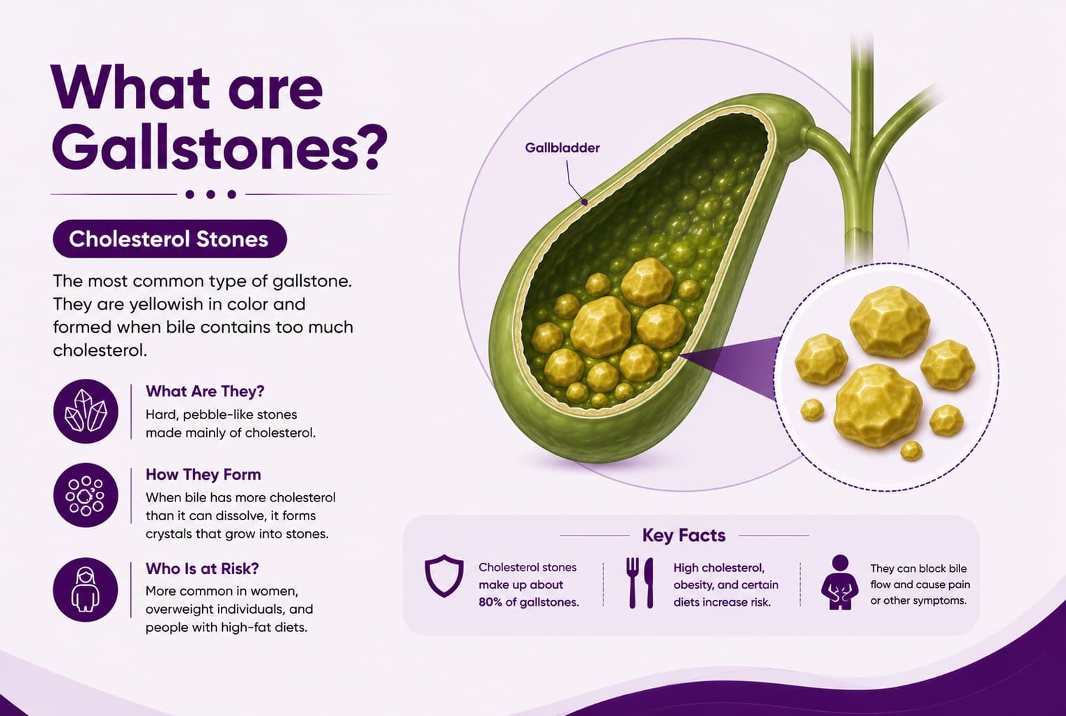 Cholesterol stones
