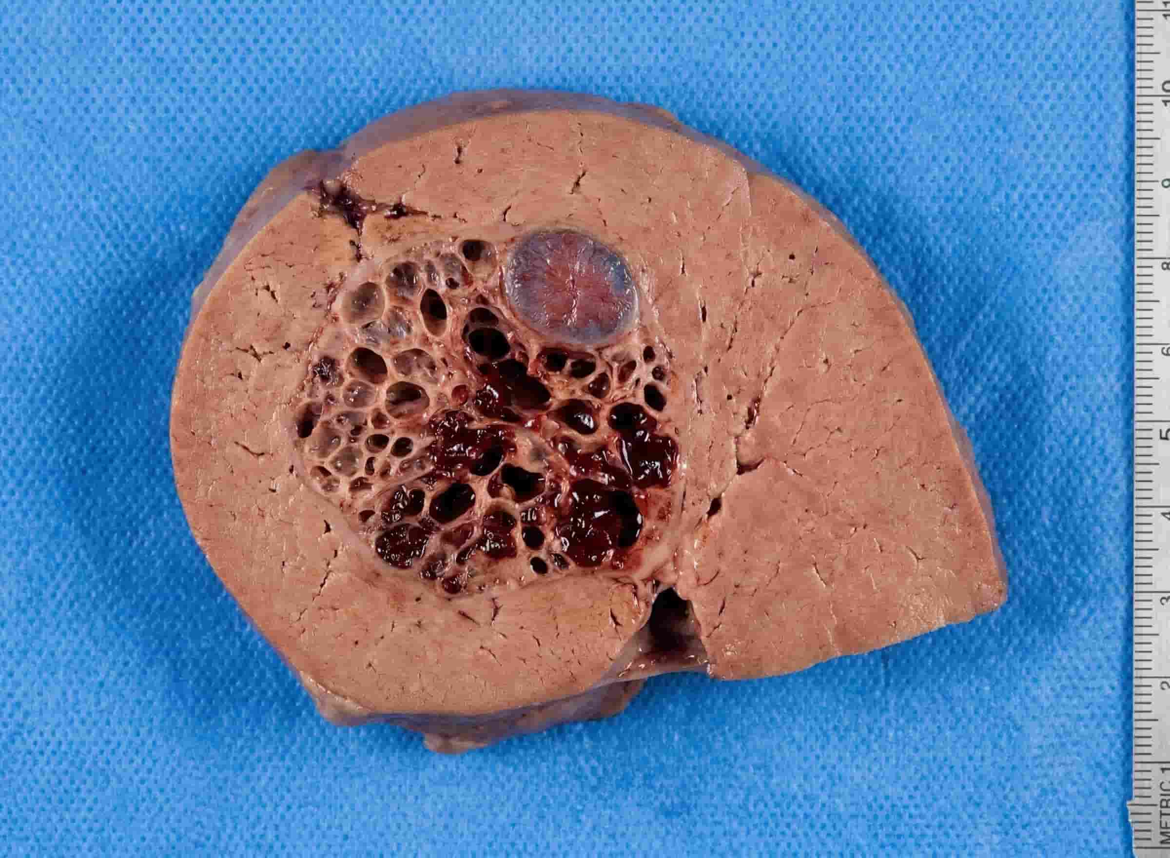Liver Hemangioma Illustration