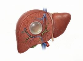 Simple Liver Cyst Illustration