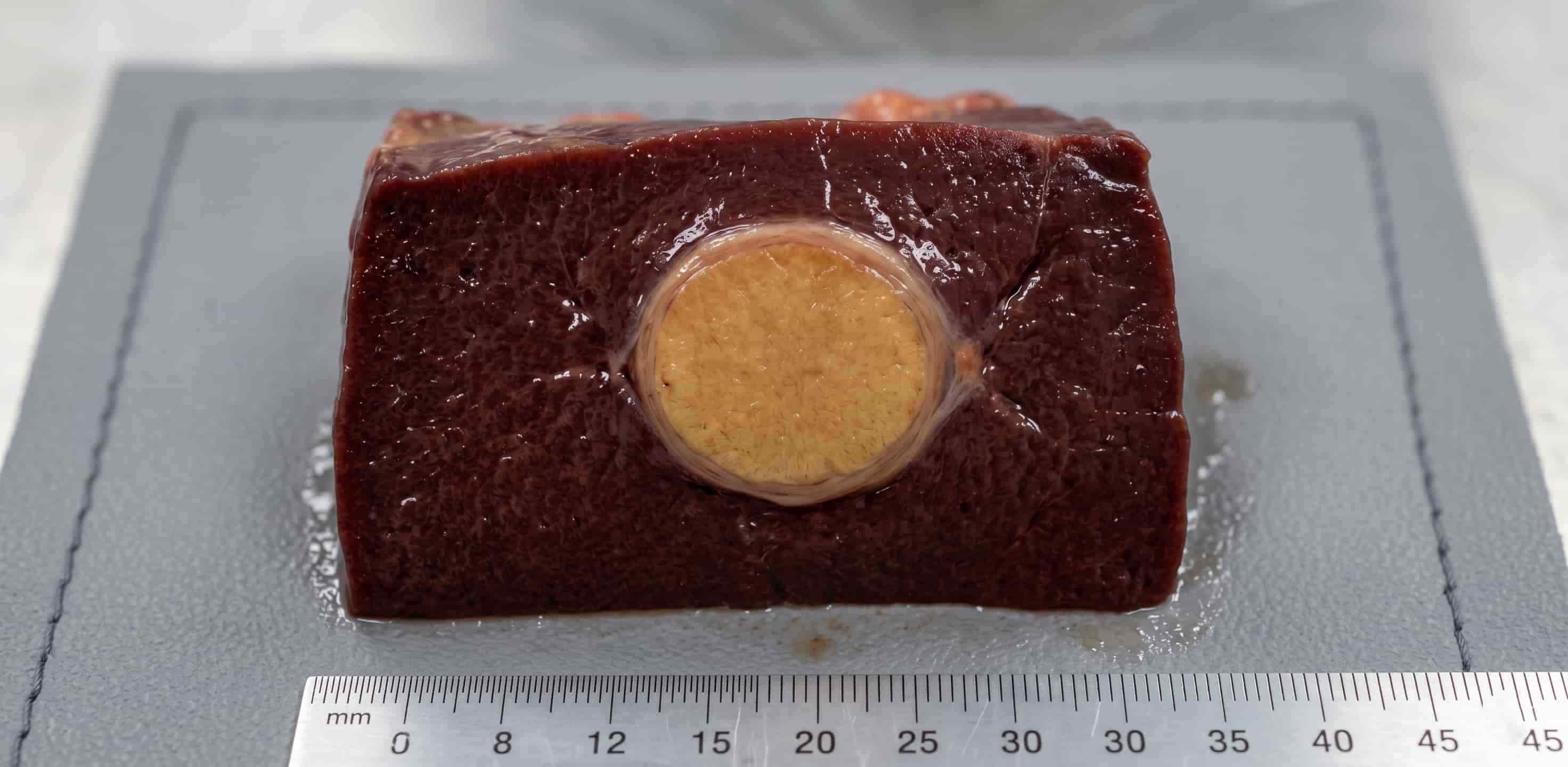 Localized benign liver tumor illustration