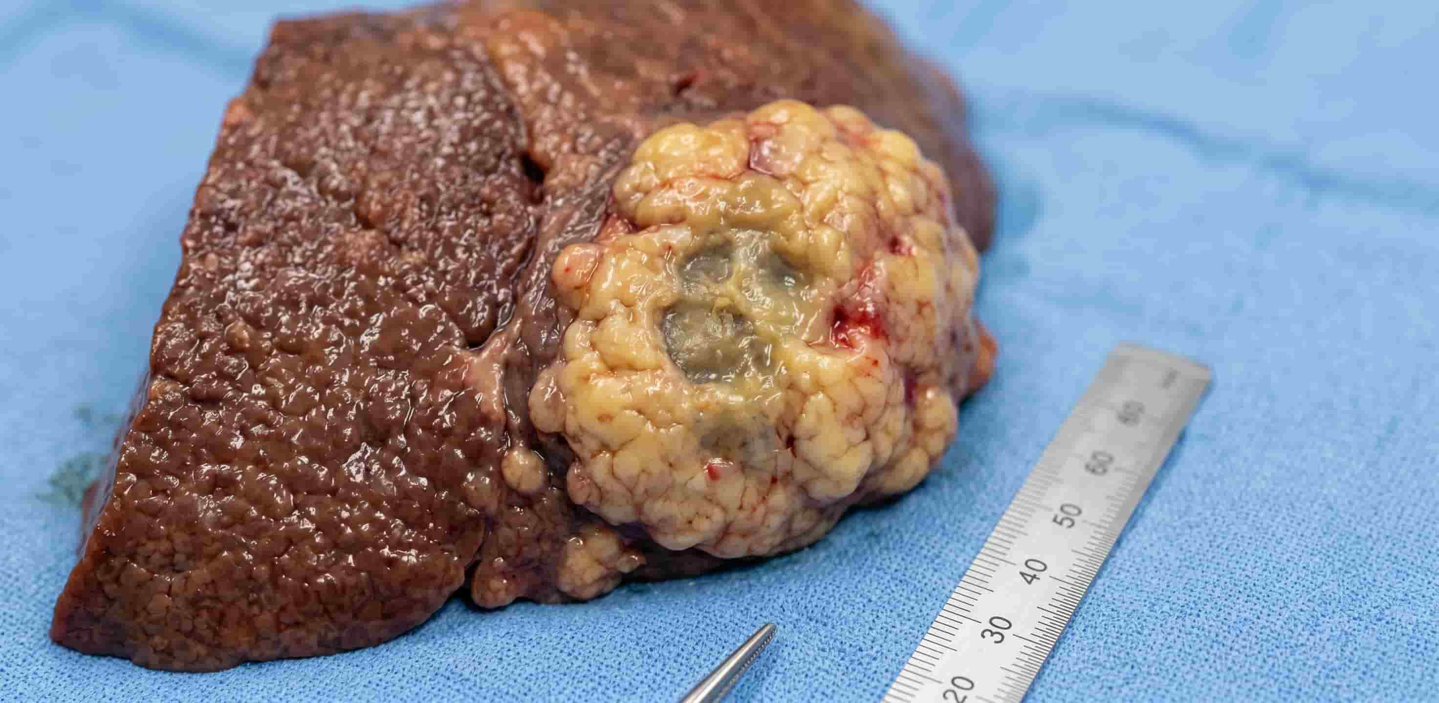 Invasive malignant liver cells illustration