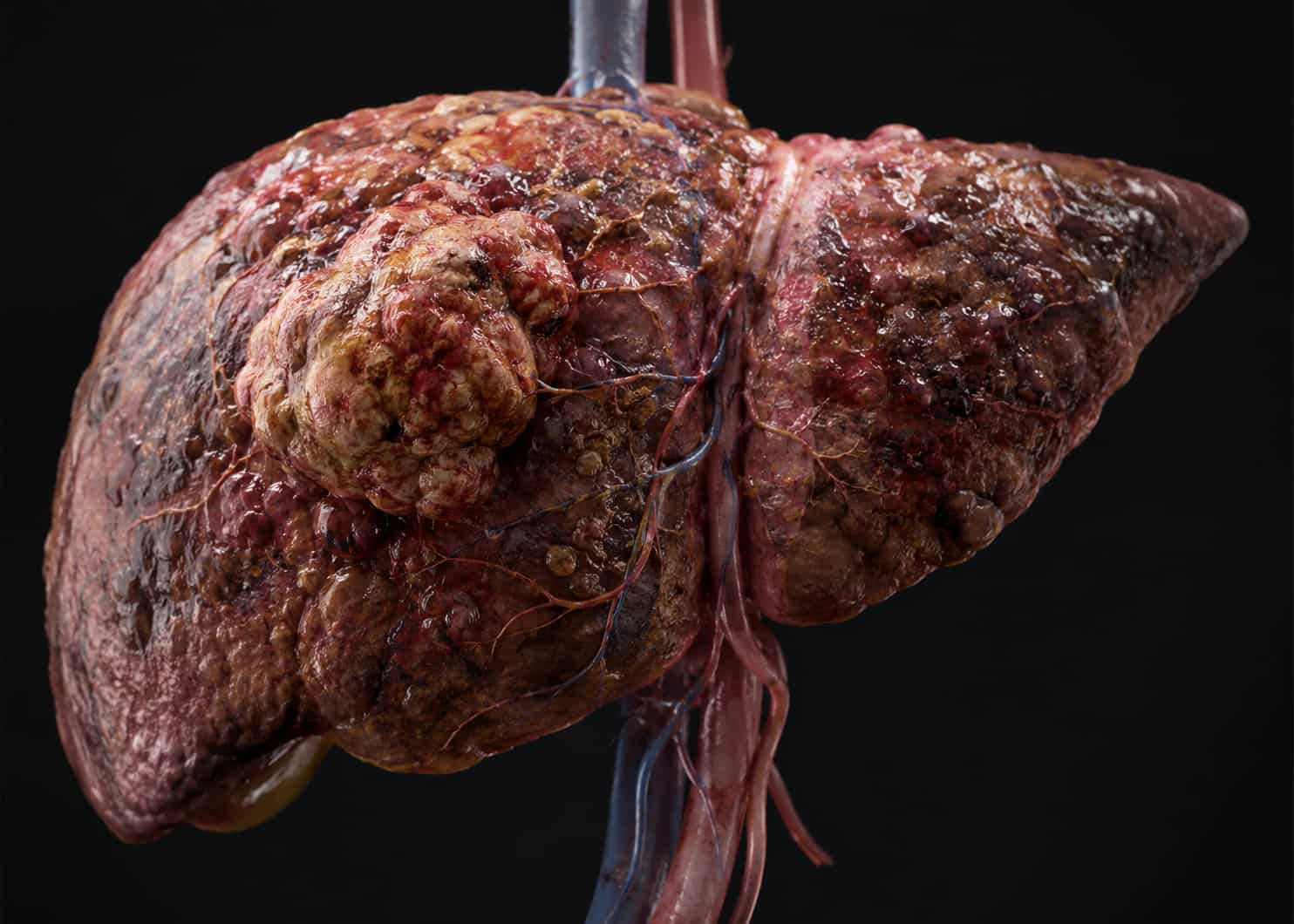 Liver Cancer Stage 3