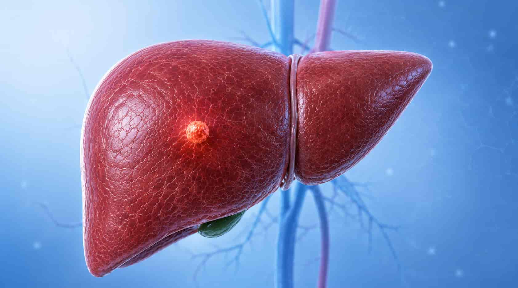 Liver Cancer Stage 1