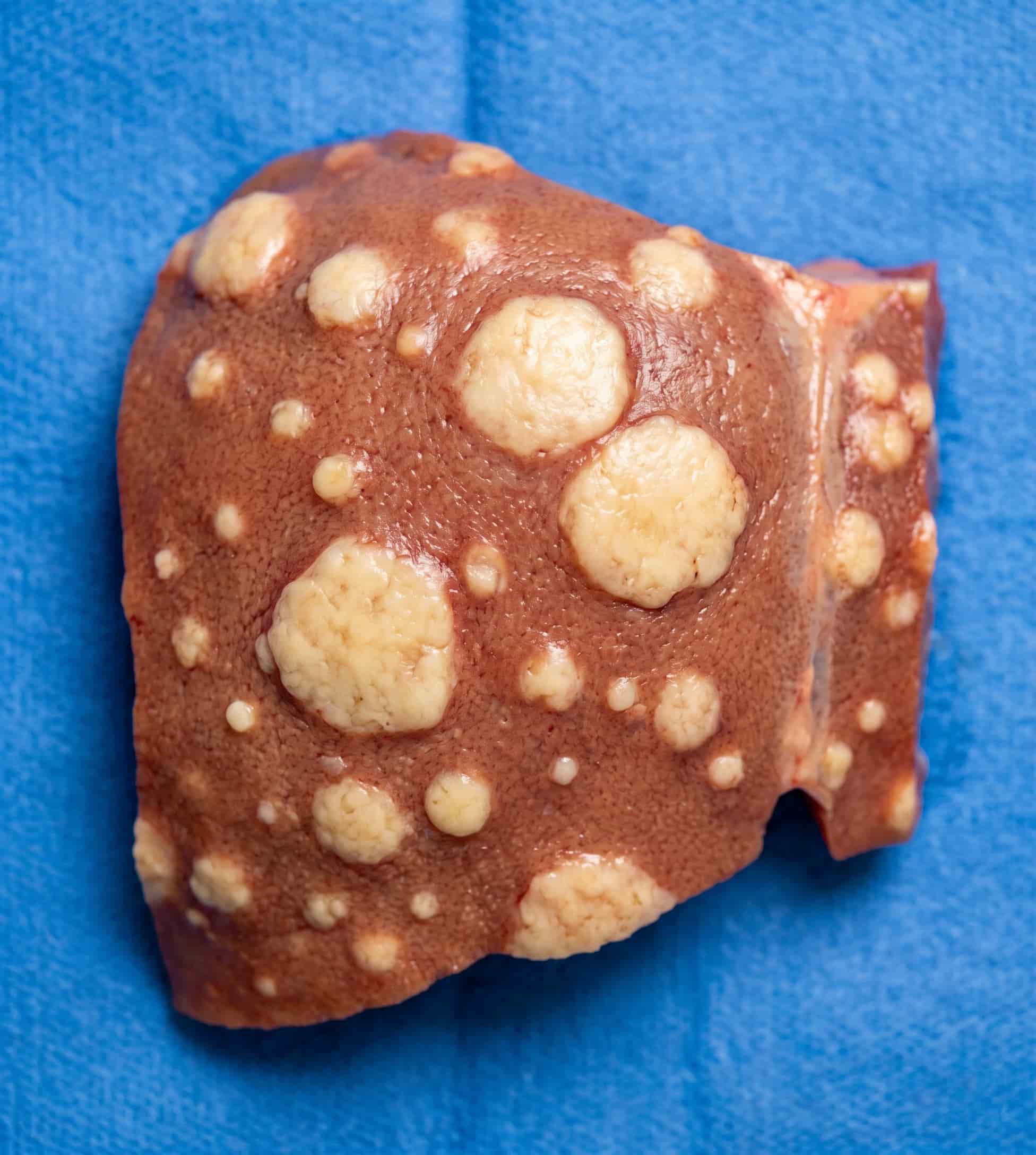 Illustration of secondary cancer spreading to the liver via bloodstream