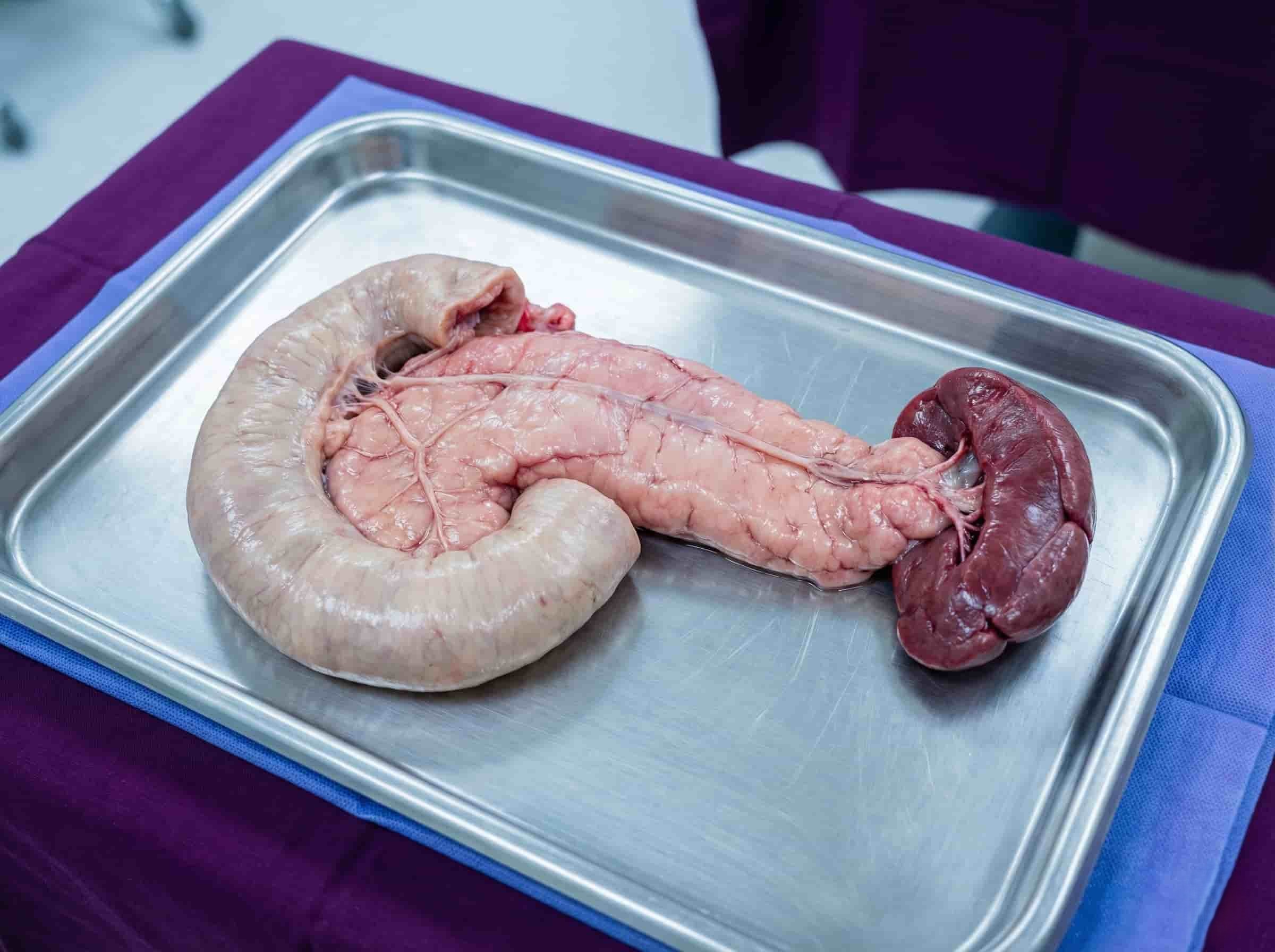 Total Pancreatectomy