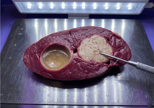Tumors
