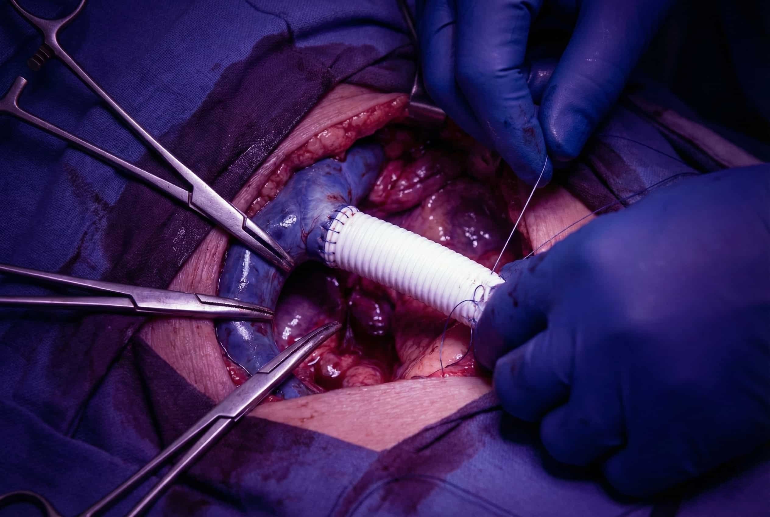 IVC Resection