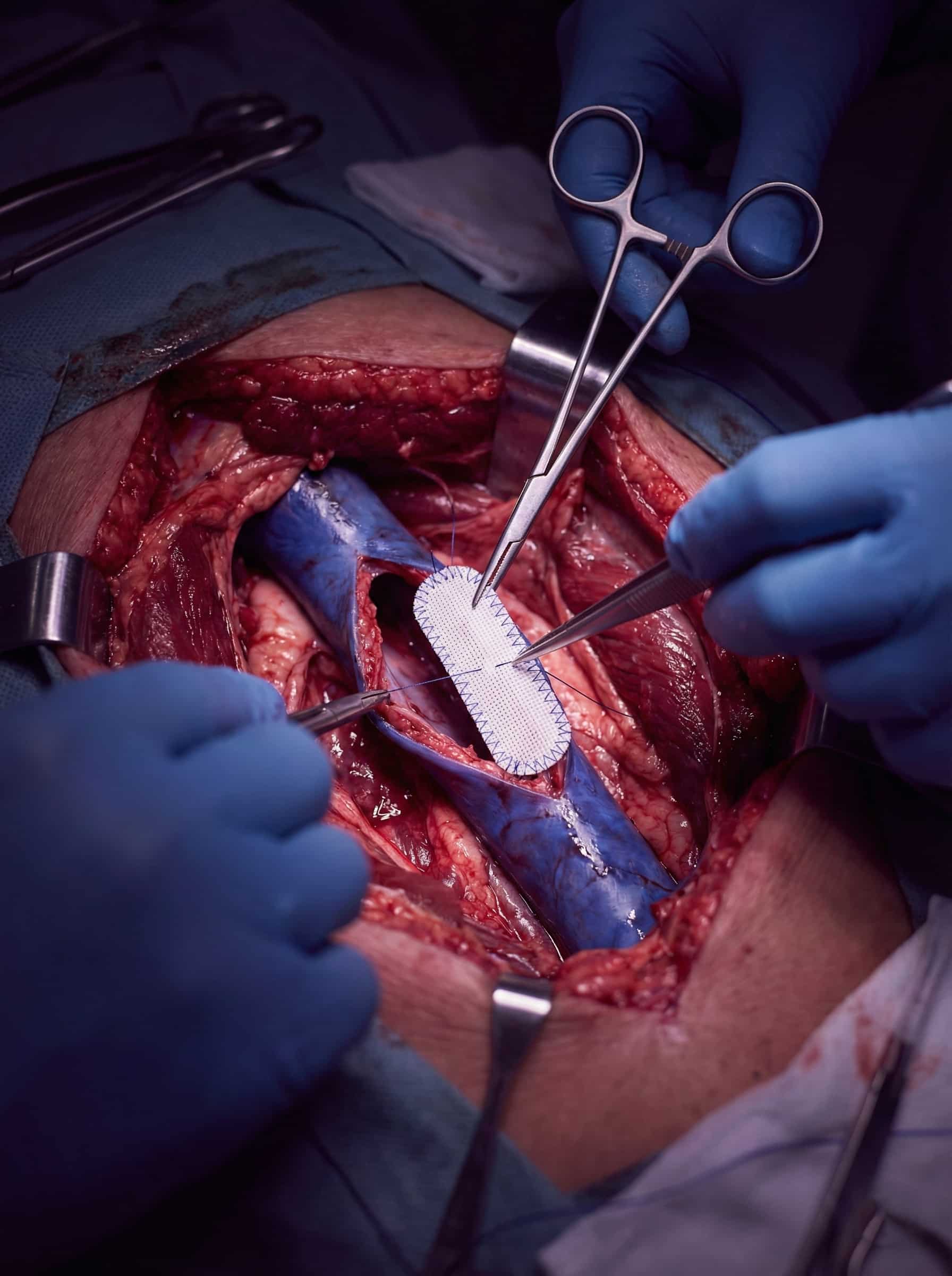 Vena Cava Surgery
