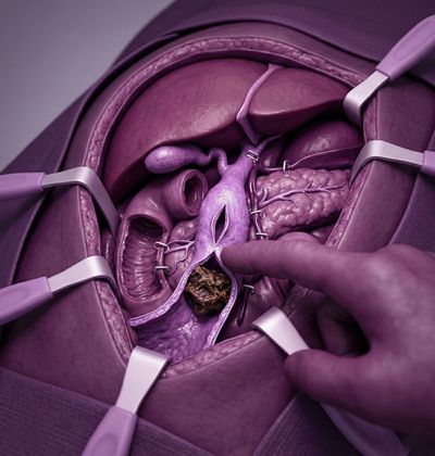 Choledocholithiasis Surgery