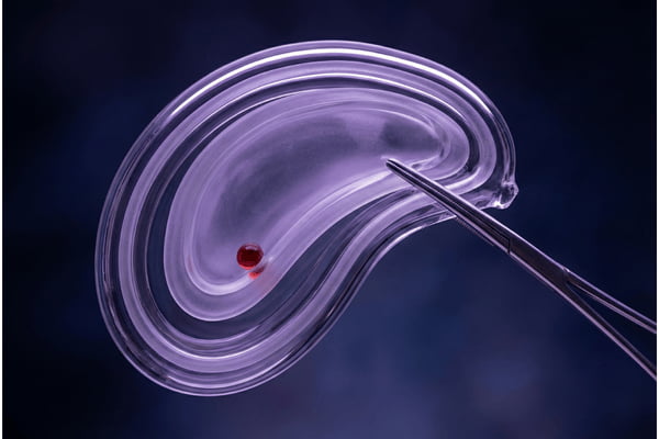 Simple Cholecystectomy