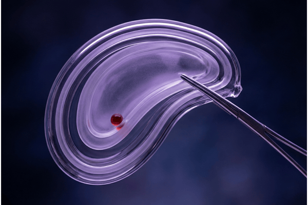 Simple Cholecystectomy