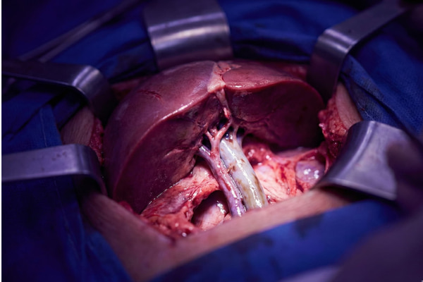 Lymph Node Removal