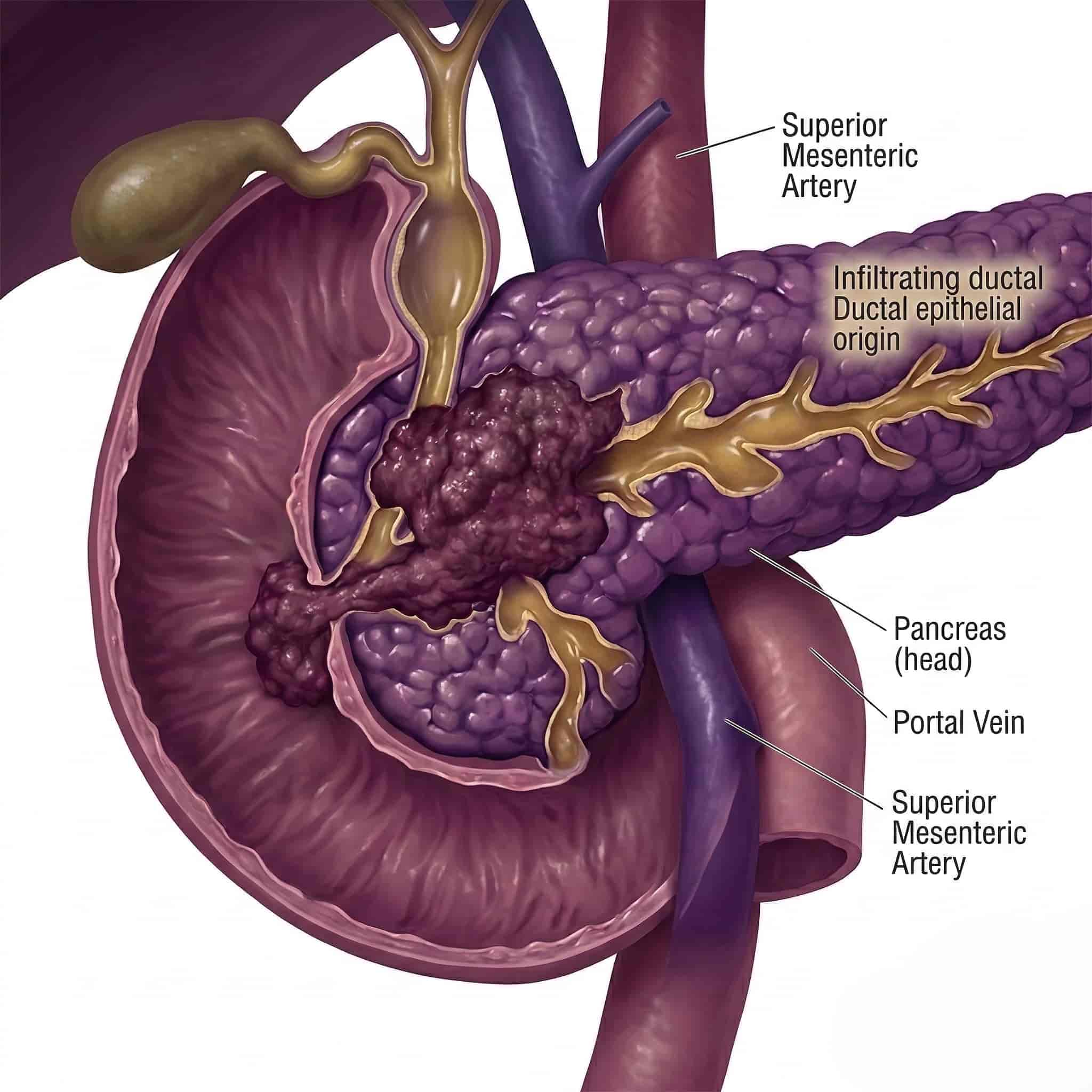 Anatomical indications for Whipple Procedure