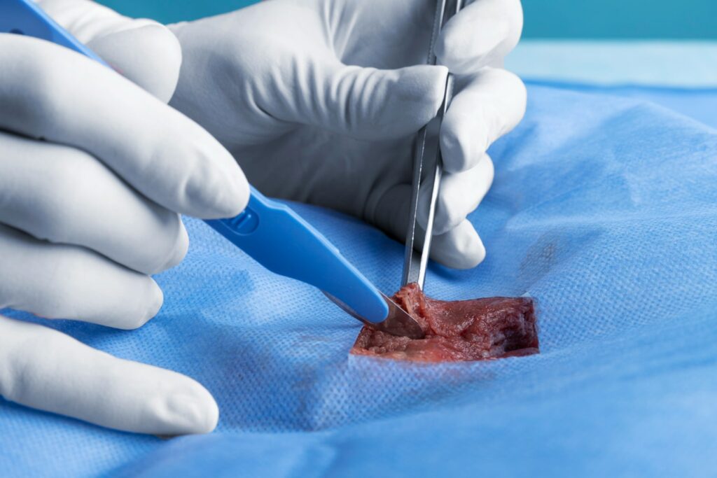 Best Gallbladder Cancer Treatment